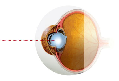 Cataract-and-Refractive-Lens-Surgery