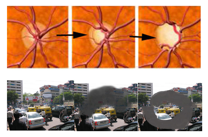 Progressive loss of visual field with corresponding loss optic nerve damage