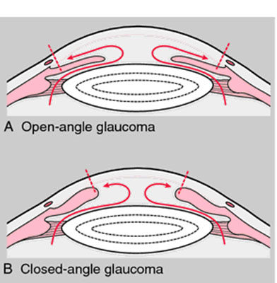 Glaucoma3