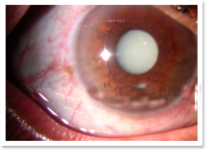Hypermature Cataract